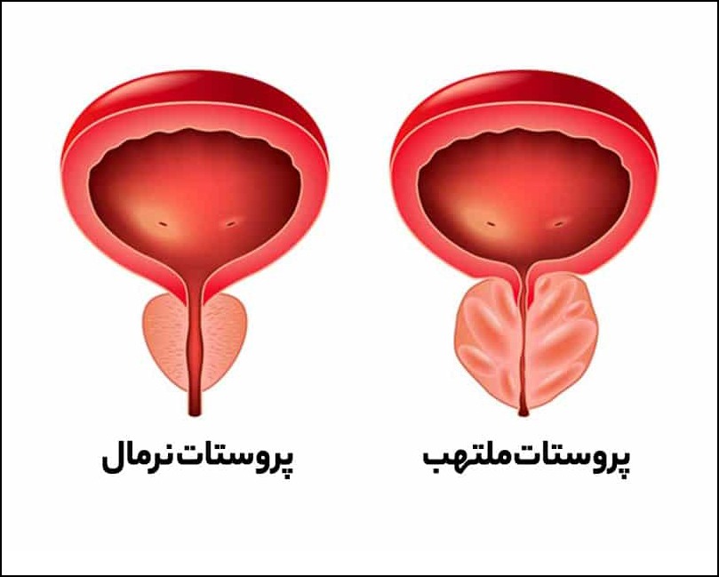 التهاب پروستات