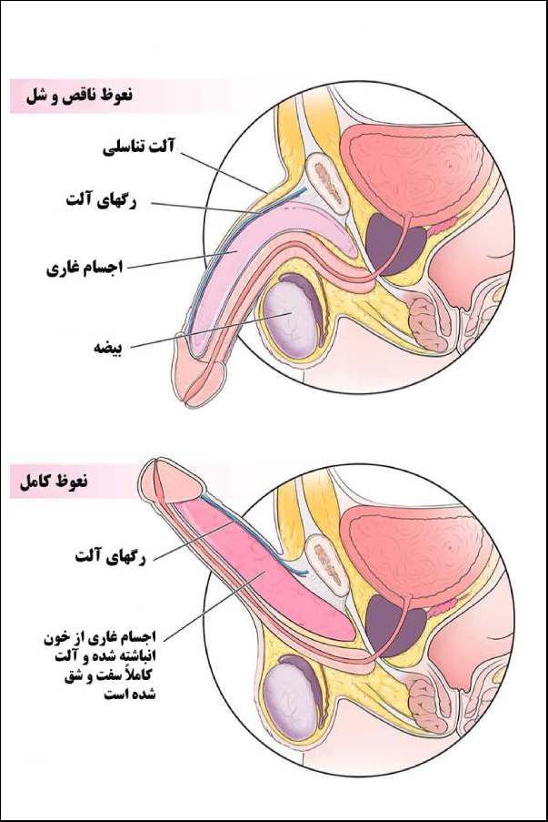 نعوظ کامل و نعوظ ناقص